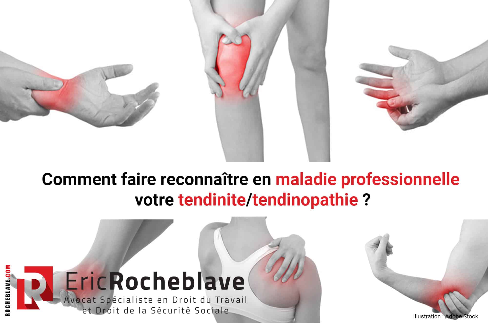 Comment faire reconnaître en maladie professionnelle votre tendinite/tendinopathie ?